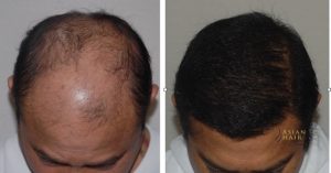Comparing Hair Transplant Costs in the Philippines: Factors and Considerations