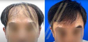 NU/HART: An Affordable Option for Hair Loss Treatment