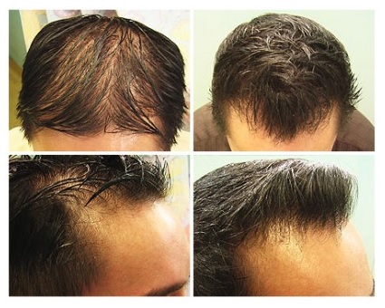 Understanding the Cost of Hair Transplant in Manila, Philippines